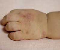 Saúde Infantil: Vereadora Márcia Baranda reforça importância de campanha sobre síndrome mão-pé-boca